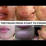 Tretinoin 0.1% Cream