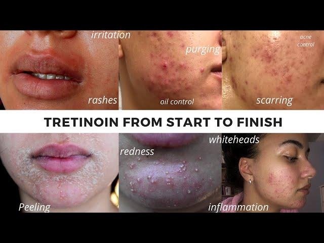 Tretinoin 0.1% Cream